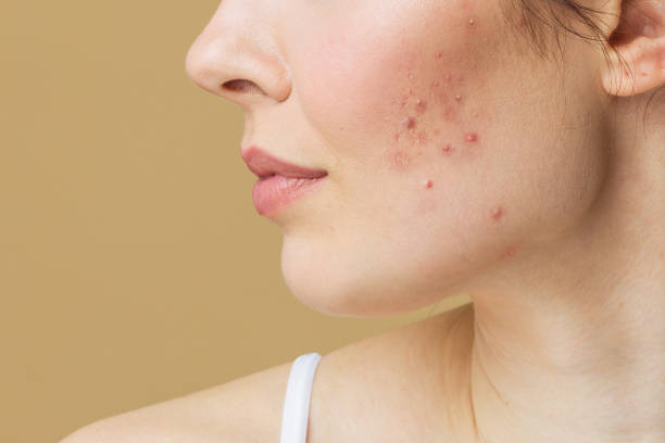 How Dirty Makeup Brushes Are Causing Your Breakouts (And How to Fix It)